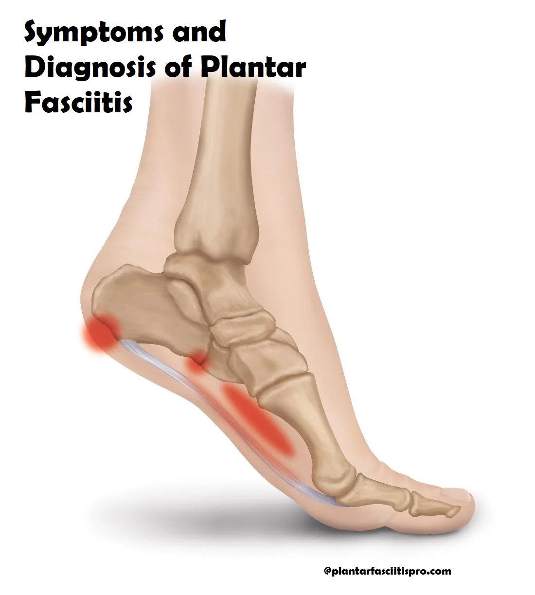Symptoms and Diagnosis of Plantar Fasciitis Complete Guide
